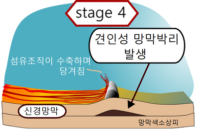 stage 4.png