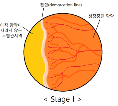 stage 1.png