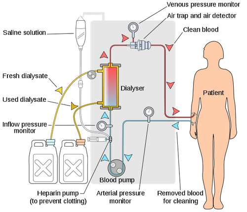 en.wikipedia.org wiki Dialysis.png