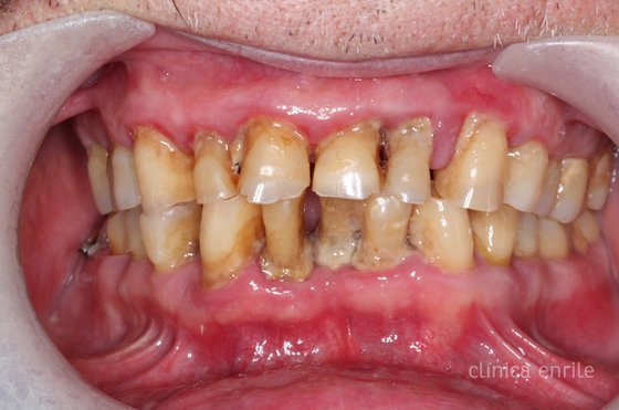 periodontitis-piorrea-01.jpg