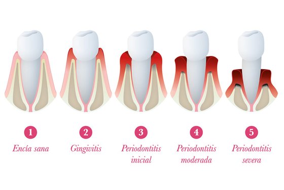 periodontitis-1024x683.jpg
