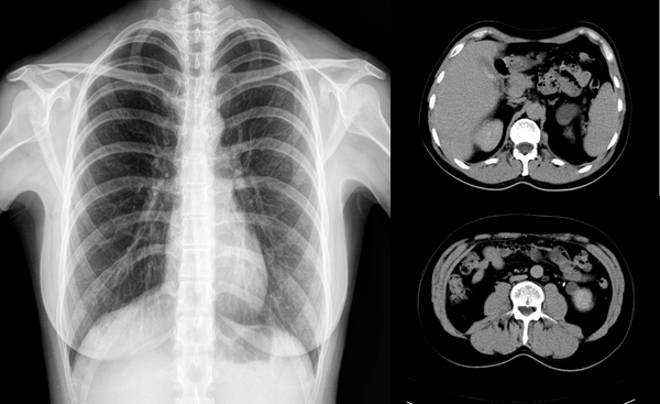 X Ray Pregnancy