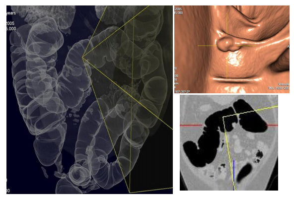 Radiology Colonoscopy Can Be Done With Ct Ct Colonography Steemit