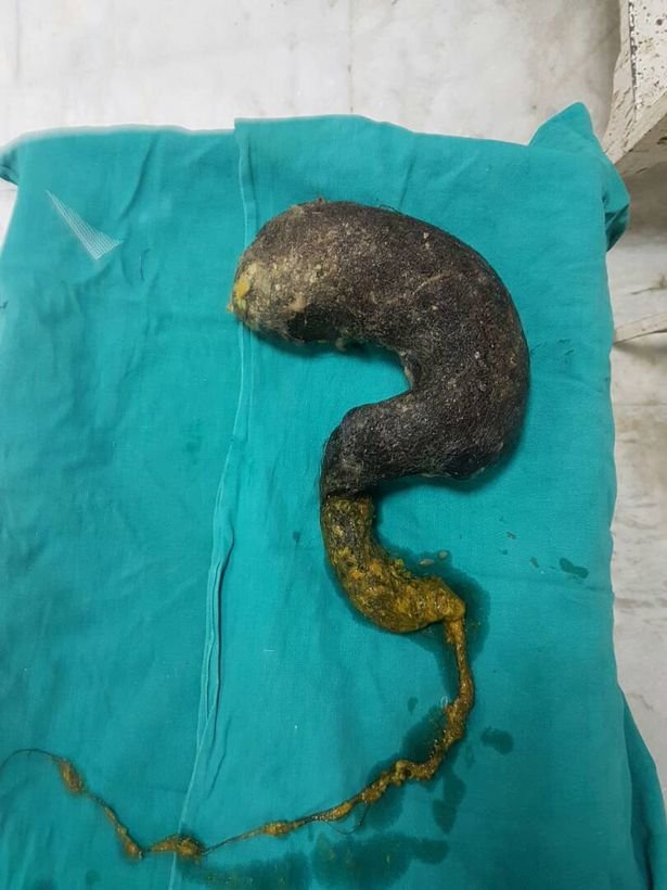 Ewww! 2kg Hairball The Size Of A Melon Is Removed From Teenager's Stomach —  Steemit