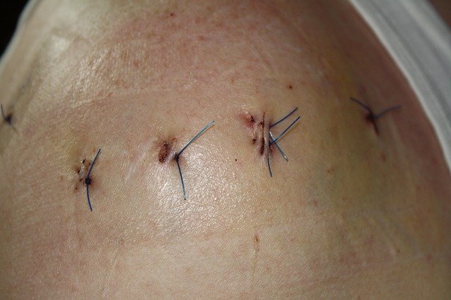 surgery-stitches