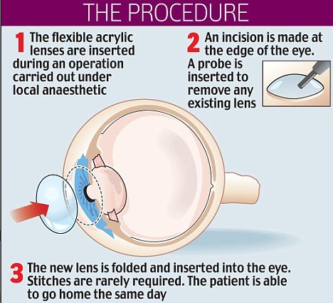 Get Superhuman Eyesight With These Bionic Lenses 3 Times Better Than 20 20 Vision Steemit