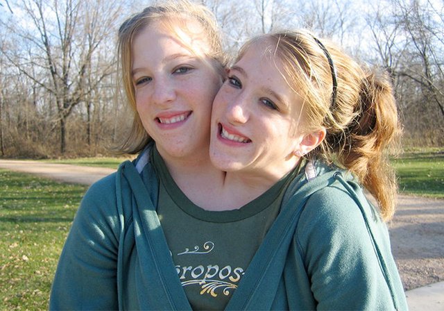 Conjoined twins Abigail and Brittany Hensel — Steemit