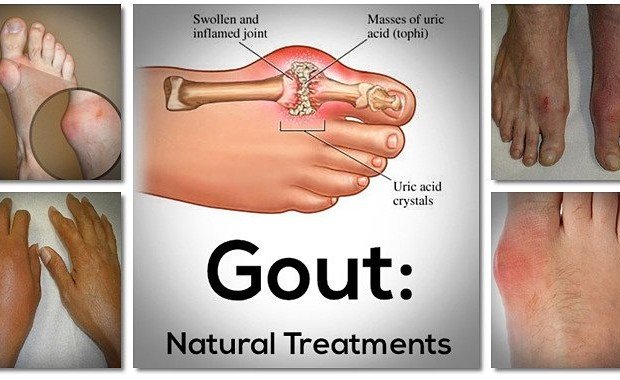 Image result for The Gout Code Review - Lewis Parker's The Gout Code Review