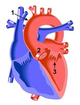 Marfan syndrome