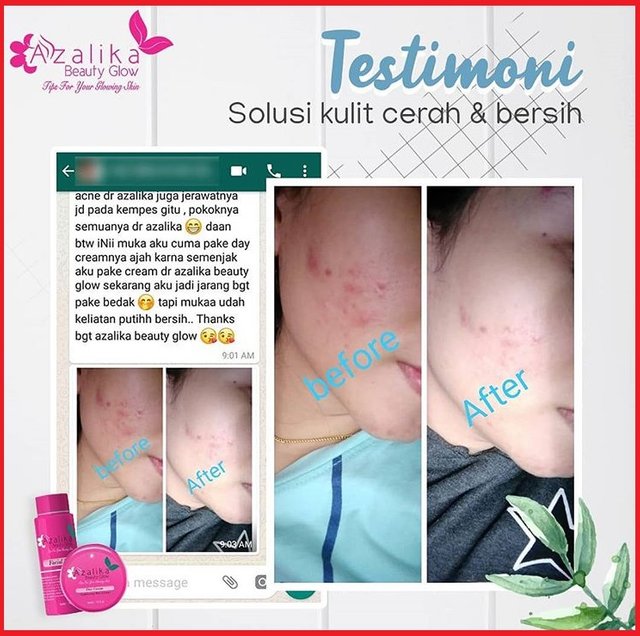 testimoni azalika acne series 2018