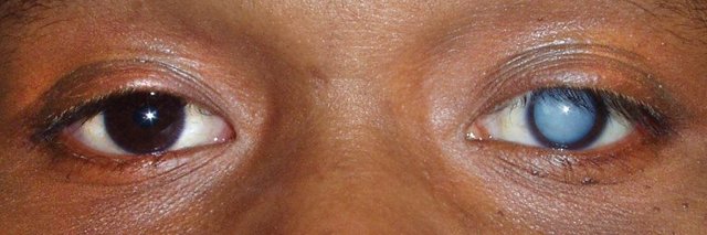 cataracts