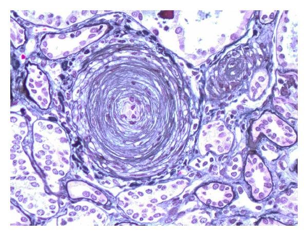 scleroderma