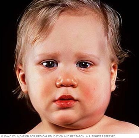 mumps