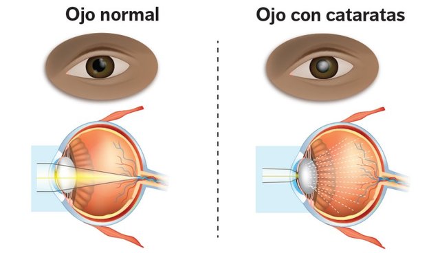 1140-normal-and-cataract-eye-esp.imgcache.rev.web.900.518.jpg