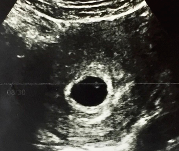 임신5주 (3).png