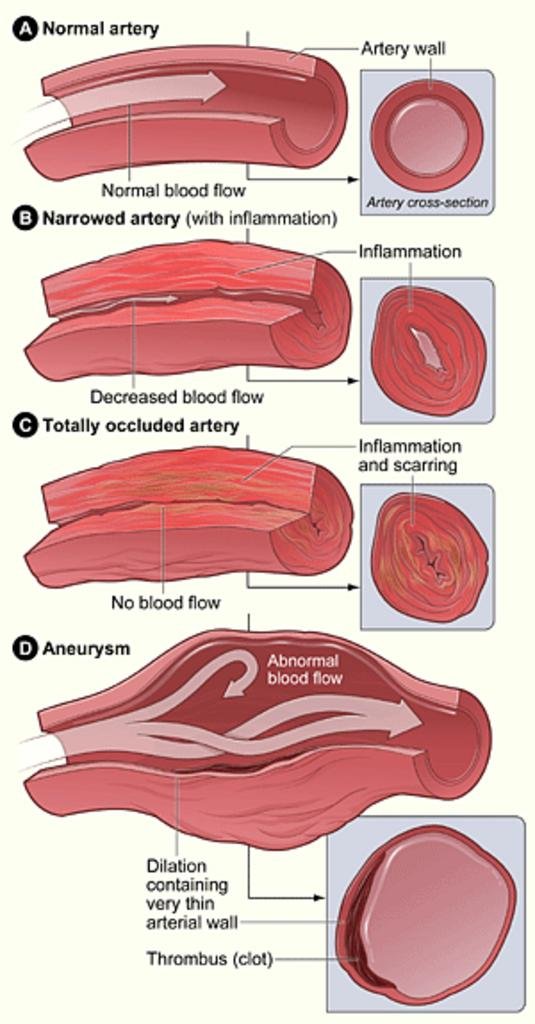 vasculitis_nih_gif.jpg