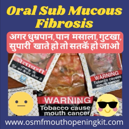 oral submucous fibrosis staging.png