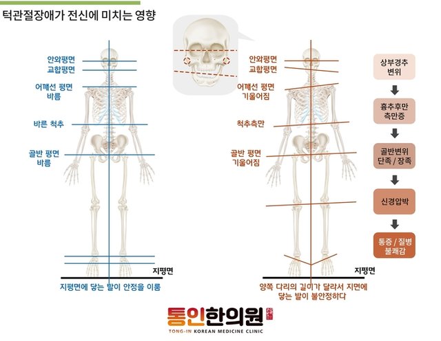 턱관절장애가 전신에 미치는 영향.jpg