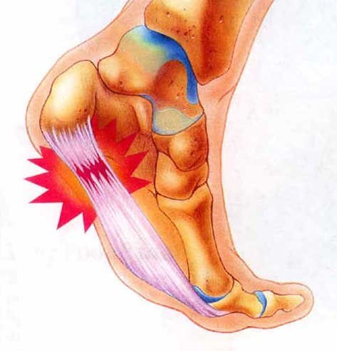 heel-bone-pain-2.jpg
