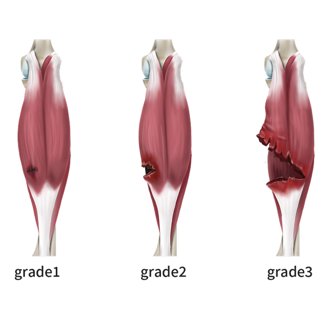 비복근파열 정도.png