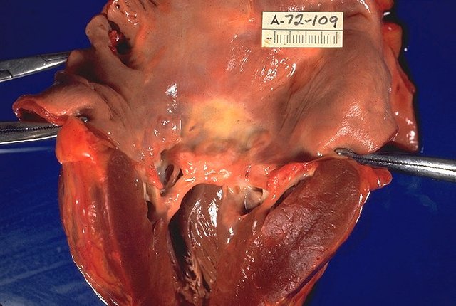 Rheumatic_heart_disease,_gross_pathology_20G0013_lores (1).jpg