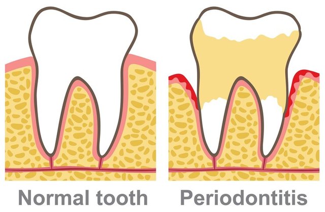 human-gum-bleeding-periodontal-disease_726294-731.jpg