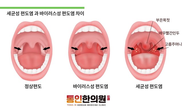 급성편도염 한약치료 종각한의원 통인한의원.jpg