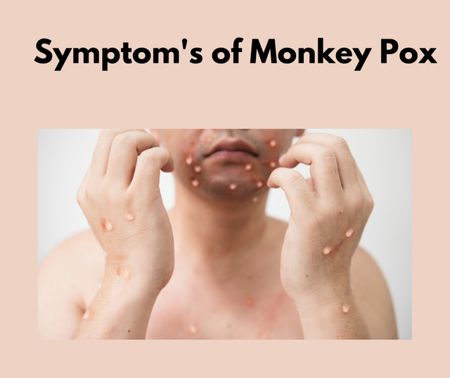 Symptoms of Monkey Pox.png