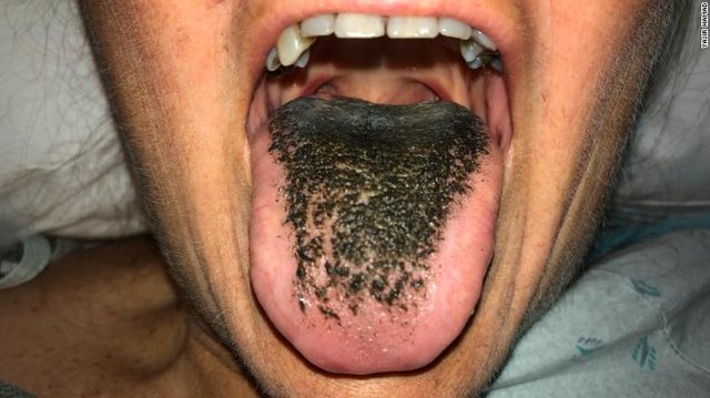 180905123544-01-black-hairy-tongue-exlarge-169.jpg