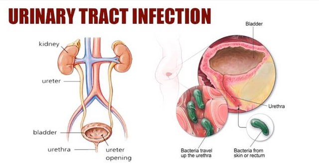 urinary-tract-infection.jpg