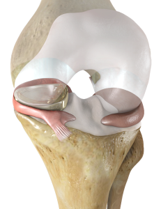 Meniscus Implants.png