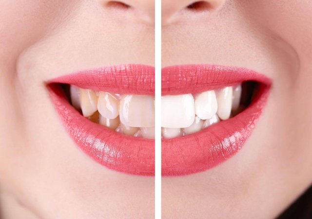 10 Reasons to Get Professional Teeth Whitening at the Dentist’s.jpg