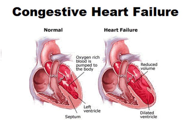 Congestive-Heart-Failure-800x500.jpg