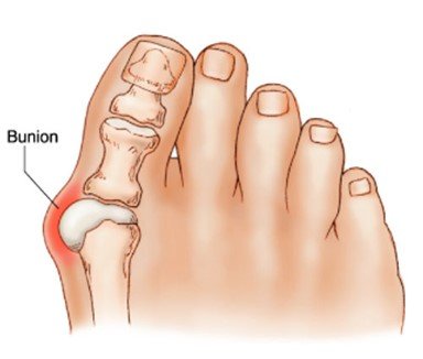 bunion.jpg