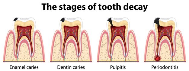 infographic-human-stages-tooth-decay_1308-93669.jpg