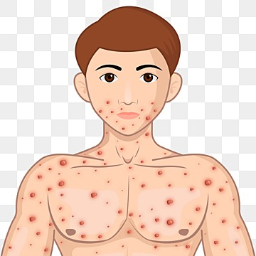 pngtree-male-face-affected-by-blistering-rash-because-of-monkeypox-or-other-png-image_4922157.png