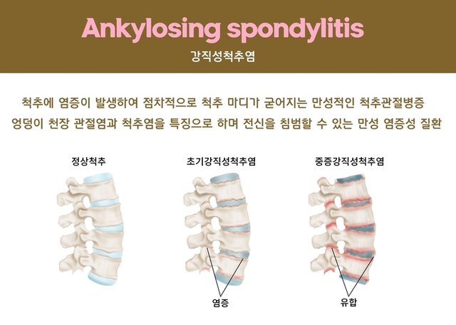 강직성척추염 종각한의원.jpg