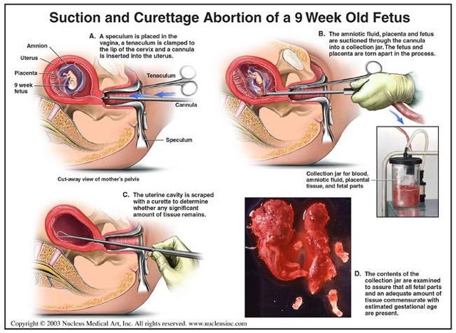 aborto-diagrama.jpg