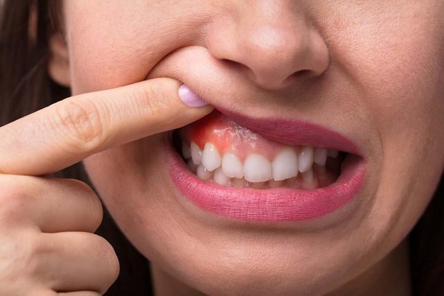 7 Mistakes in Treating Gingivitis.jpg