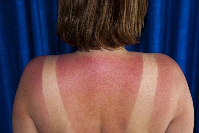 sunburned-woman.jpg