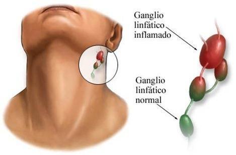 Ganglios-linfatico-especifico.jpg