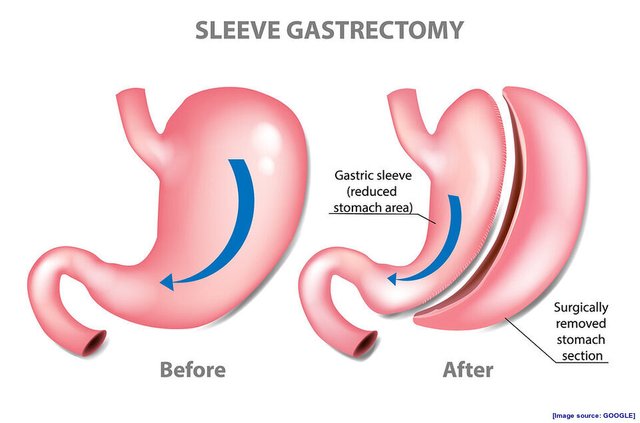 Sleeve Gastrectomy.jpg