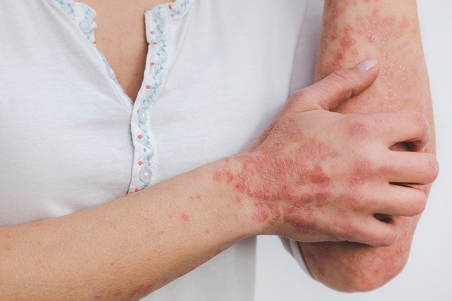 psoriasis-5996424_640.jpg