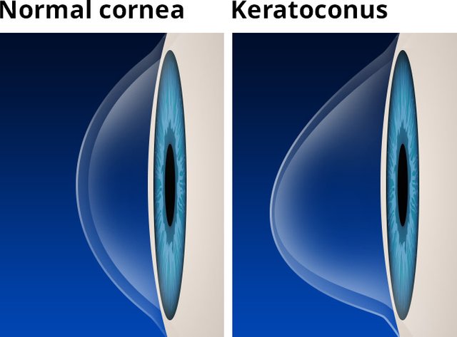 keratoconus-with-labels-660x488.jpg