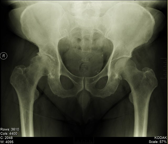 Civilian Ortho R Hip 1 (2).JPG