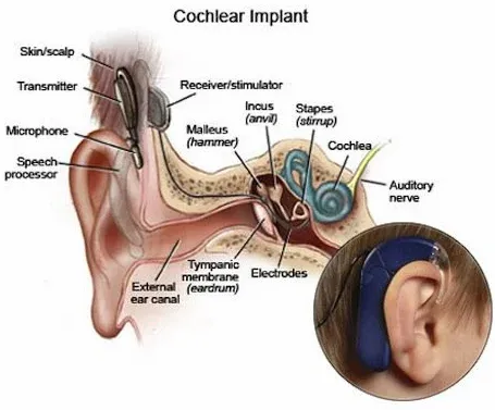 cochlear-implant-500x500.webp