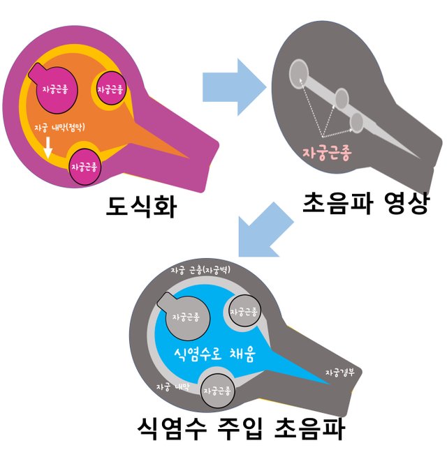 식염수주입초음파.jpg