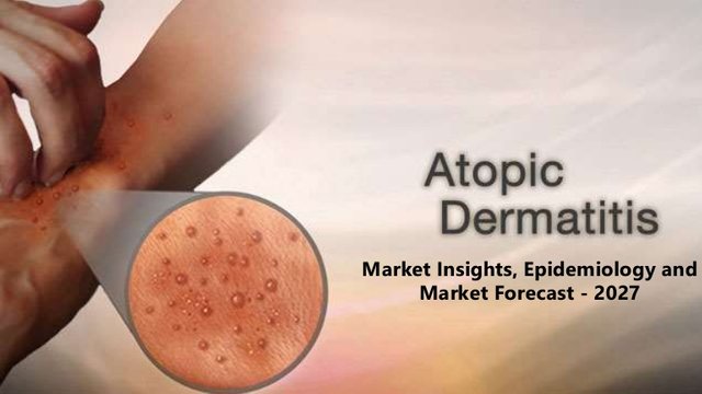 atopicdermatitis-180221174116-thumbnail-4.jpg