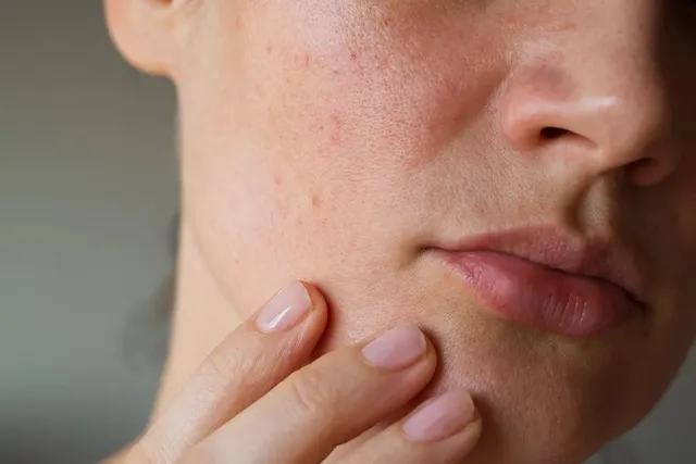 rosacea.jpg