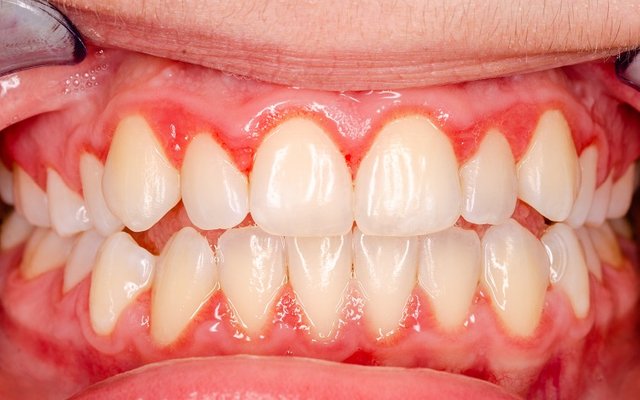 gingivitis-teeth.jpg